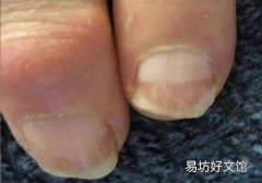 林赛氏指甲怎么治是大病前兆吗 林赛氏指甲并不是你以为的那样！