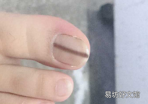 指甲有黑色竖纹是什么原因 指甲有黑色竖纹是身体的什么信号
