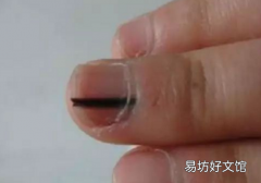 脚指甲里面有黑块不痛 是黑色素瘤吗？怎么治？