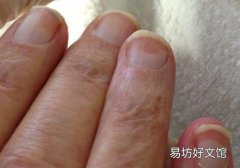 林赛氏指甲按压会不会痛 林赛氏指甲传染吗