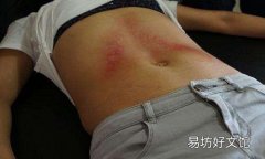 刮痧对痔疮有效果吗 痔疮刮痧刮哪里最好