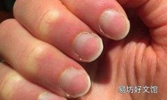 林赛氏指甲是什么 怎么鉴别是林赛氏指甲
