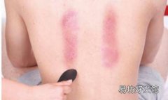 颈椎病刮痧方法图解 刮痧对颈椎有好处吗