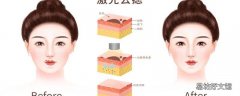 夏天可以去点痣吗 夏天点痣会不会留疤