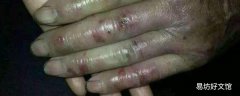 冬天手裂口子怎么办 天一冷手就裂口子是怎么回事