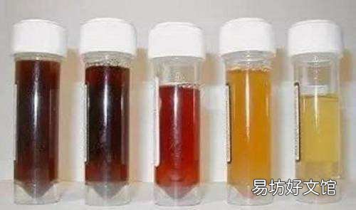 平时怎么判断自己尿酸高不高 尿液分析怎么看尿酸高不高