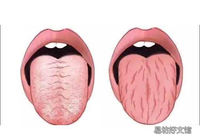 舌头上有裂纹是什么病症征兆 舌头裂口子是怎么回事