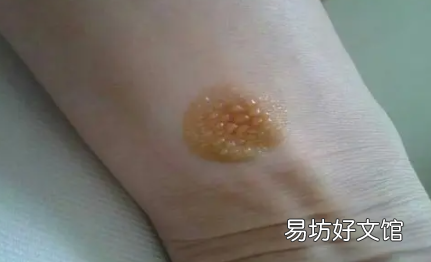 艾灸起了水泡還能灸嗎 艾灸后起水泡如何處理