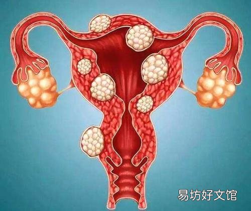 子宫肌瘤有癌变的风险,女性要注意这些预防子宫肌瘤的方式