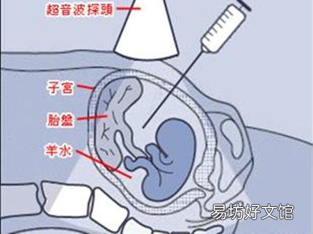 羊水穿刺多少钱 做羊水穿刺需要空腹吗