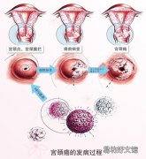 宫颈癌复发最明显症状 50岁宫颈癌有哪些症状？