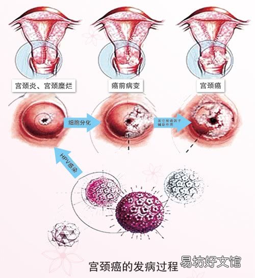 宮頸癌復(fù)發(fā)最明顯癥狀 50歲宮頸癌有哪些癥狀？