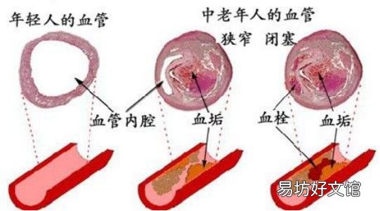 患有脑梗能活几年 大面积脑梗塞能活几年